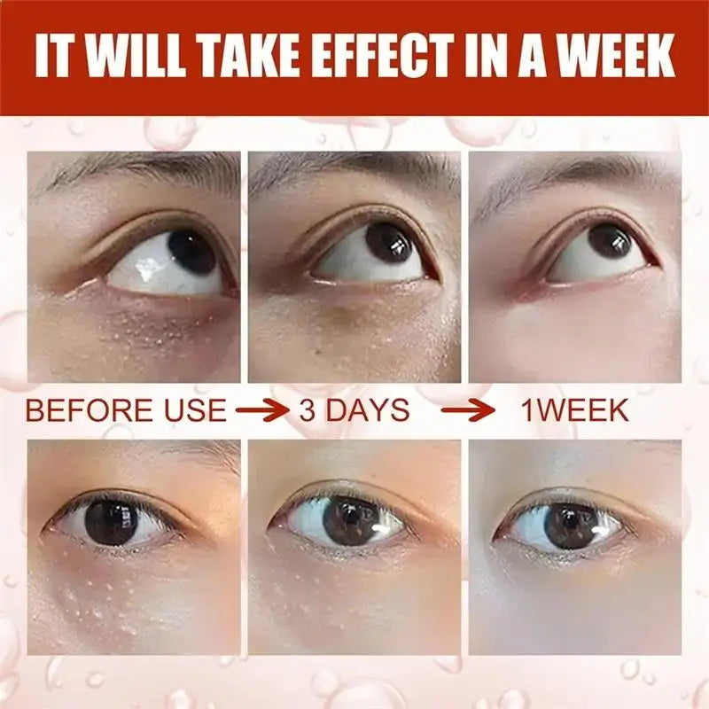 Remove Eye Fat Particles Serum Milia Treatment Products Anti Puffiness Anti Inflammatory Repair Skin Barrier Korean Skin Care